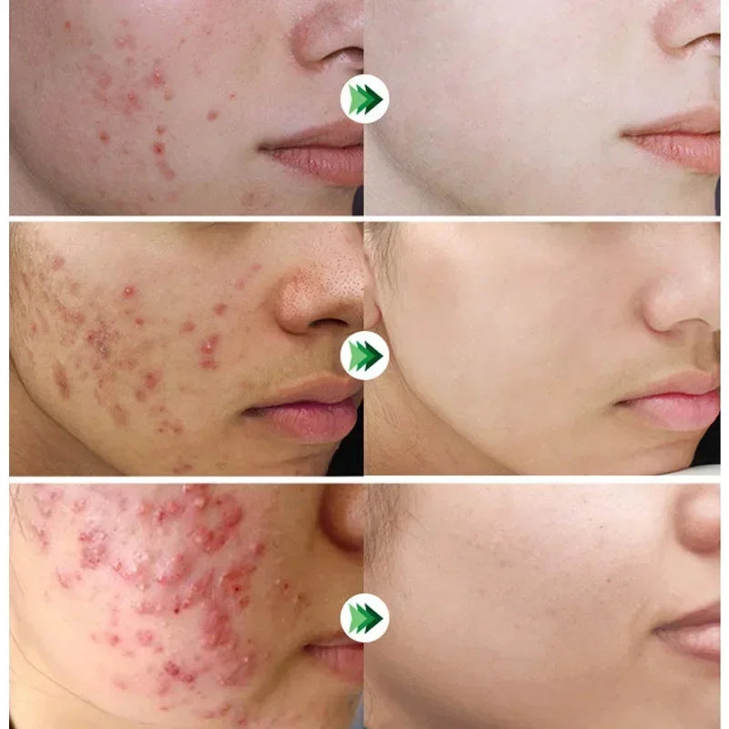 Pore-Fect Glow: Salicylic Acid Cream for Clear, Tight, Radiant Skin!