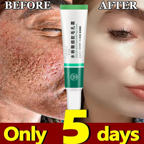 Pore-Fect Glow: Salicylic Acid Cream for Clear, Tight, Radiant Skin!