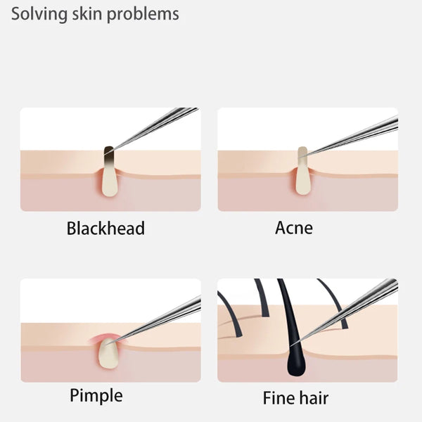Acne Blackhead Removal  Stainless Steel Skin Care Kit