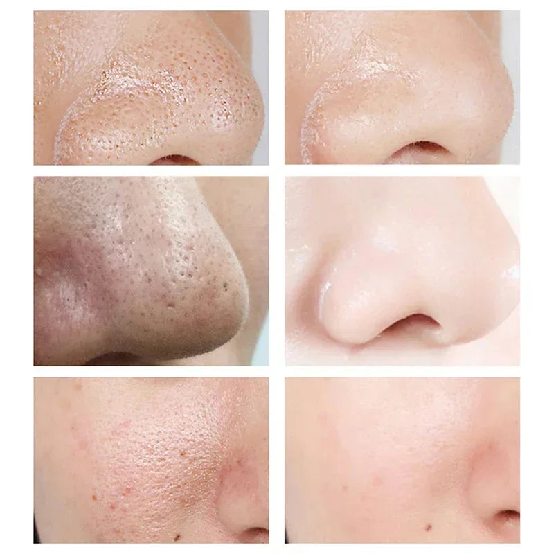 Pore-Fect Glow: Salicylic Acid Cream for Clear, Tight, Radiant Skin!